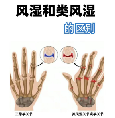 風濕和類風濕的區別