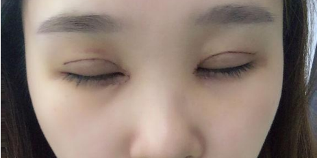 開內(nèi)眼角全切雙眼皮一個月能恢復(fù)什么程度