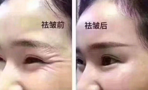 打除皺針會老得更快嗎