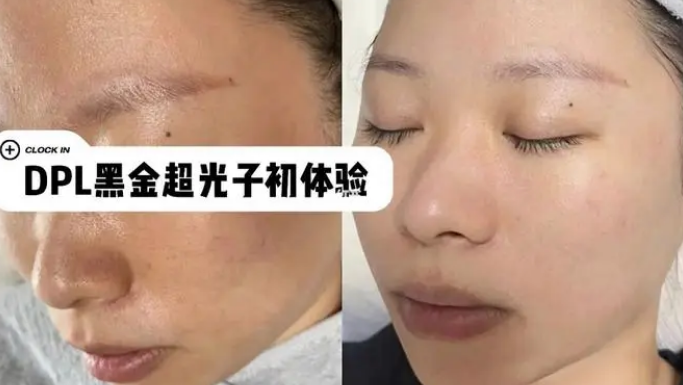 黃金超光子和黑金超光子的區別