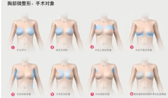 隆胸有哪幾種方式