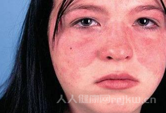紅斑狼瘡最怕什么季節
