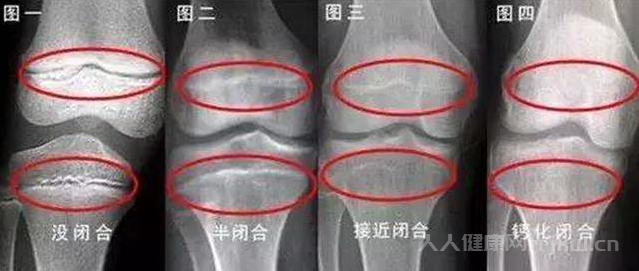 膝蓋兩邊凹陷多深才算骨骺線閉合