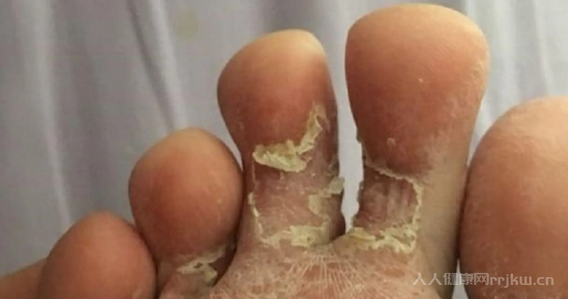 腳氣為什么反反復(fù)復(fù)一直好不了