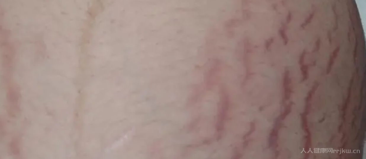 生過孩子的人一定會有妊娠紋嗎？