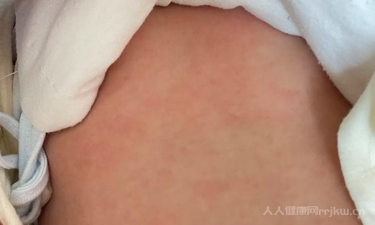 為什么得了濕疹不能吃冰的東西