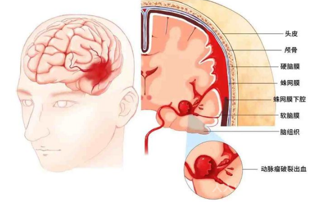 硬膜下血腫是什么意思