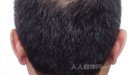 芝麻丸對脫發有效嗎
