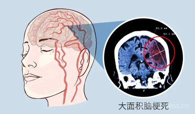腦梗是什么原因引起的