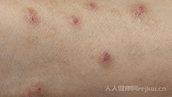 皰疹是因為什么原因引起的