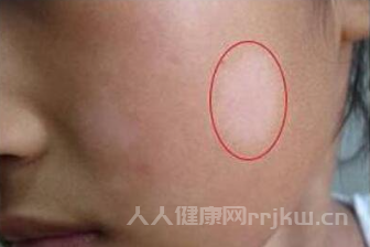 皮膚有白斑是什么情況