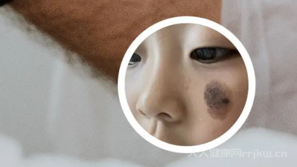 嬰兒的胎記是怎么形成的