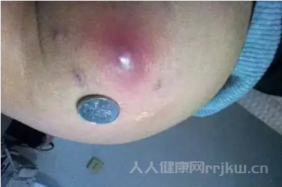 陰痙上面長了一個疙瘩怎回事