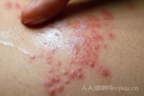 艾滋病的癥狀表現(xiàn)
