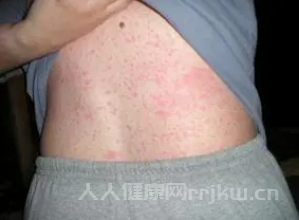 藥物過敏皮疹多久能消