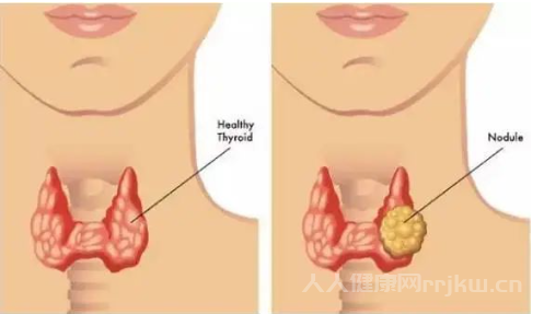 甲狀腺瘤是什么病