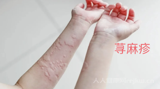 蕁麻疹怎么引起的