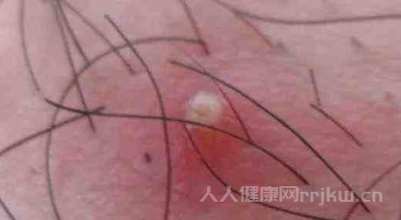 陰囊潮濕是怎么回事