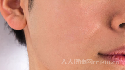 臉上過敏發紅發癢怎么治