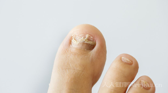 灰指甲用什么藥品最有效