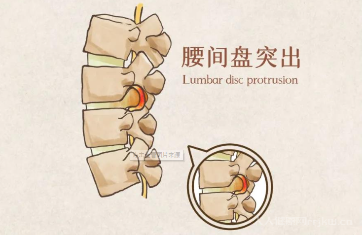 腰間盤突出的鍛煉方法