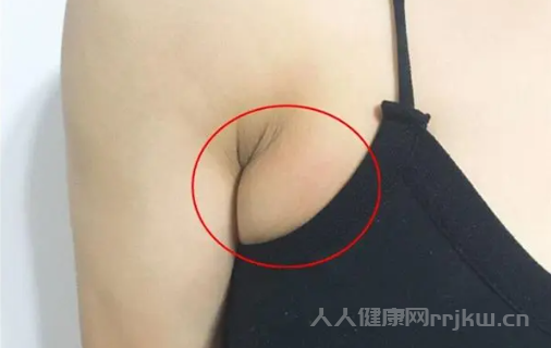 什么是副乳
