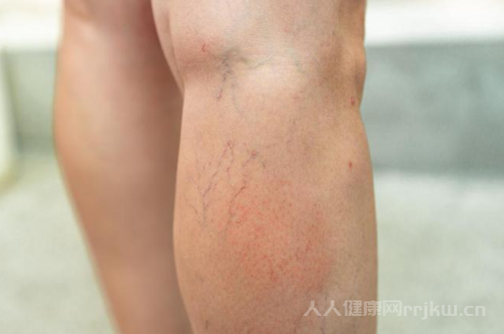 靜脈曲張是什么原因引起的