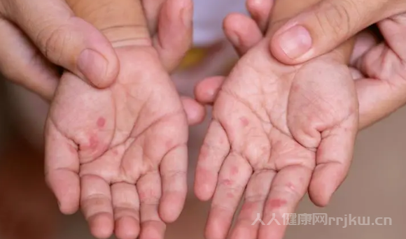 手足口病會傳染大人么圖1