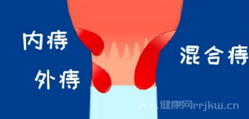 痔瘡怎么引起的圖2