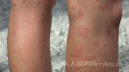 治蕁麻疹的中藥有哪些
