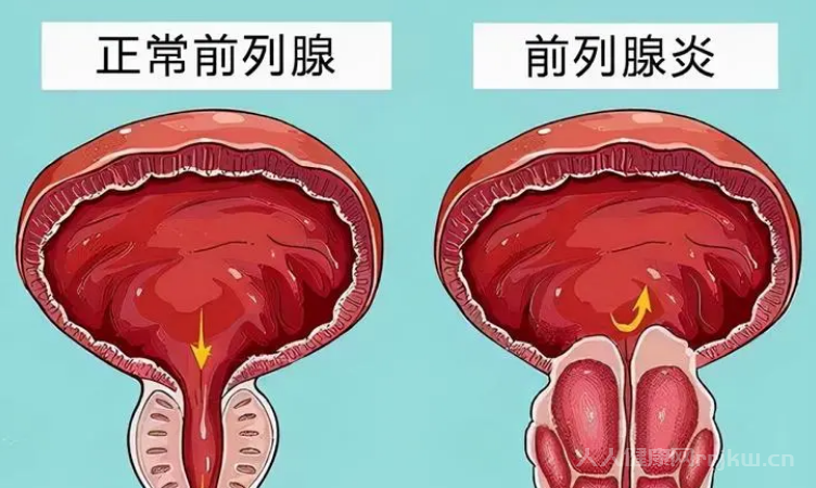 前列腺炎危害9種常見危害解析