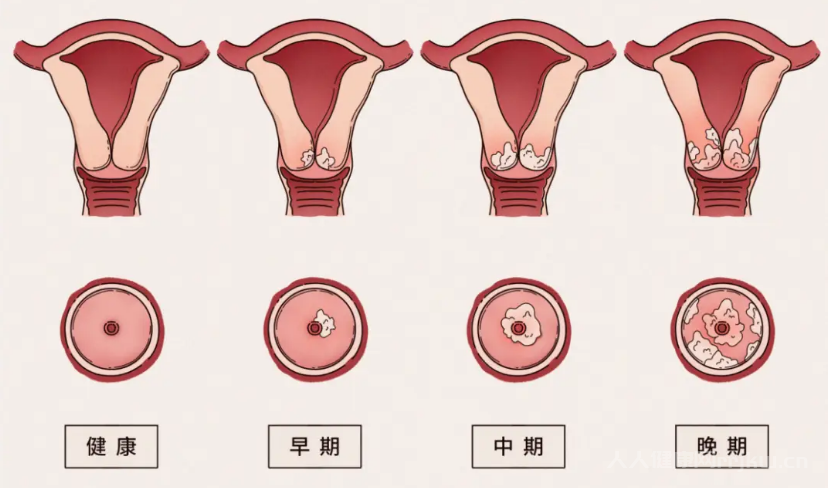 宮頸病變的五個階段是什么
