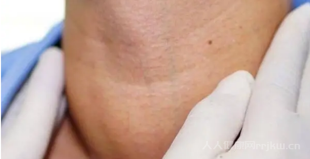 甲狀腺3類結節嚴重嗎