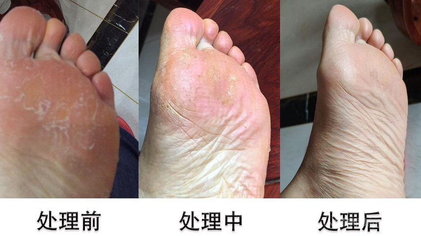 紅霉素治腳氣真的有用嗎？
