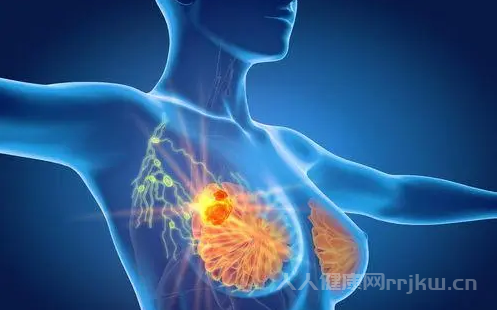 乳腺癌的早期癥狀和前兆