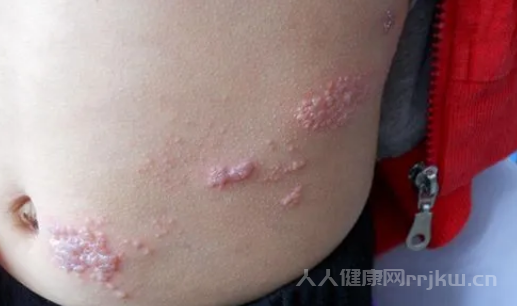 乳腺癌的15個征兆