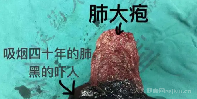 肺大泡是什么原因造成的能治好嗎
