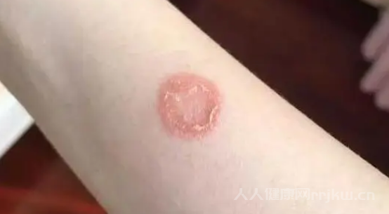 怎么判斷人得了貓癬