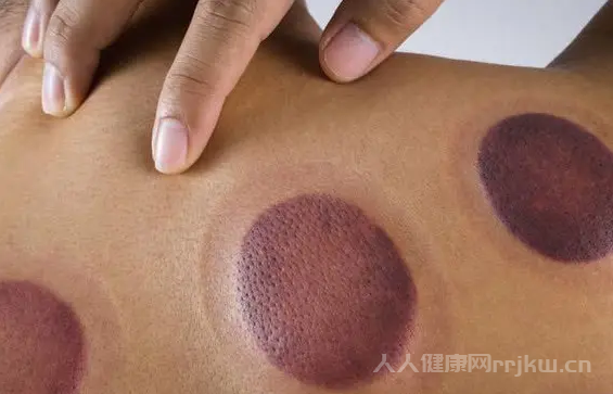 濕氣重是拔罐好還是汗蒸好