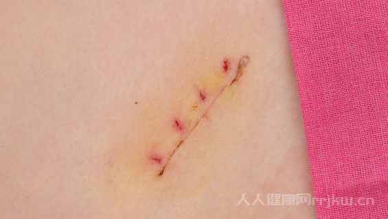 蕁麻疹能不能徹底根治 蕁麻疹徹底根治有哪些辦法