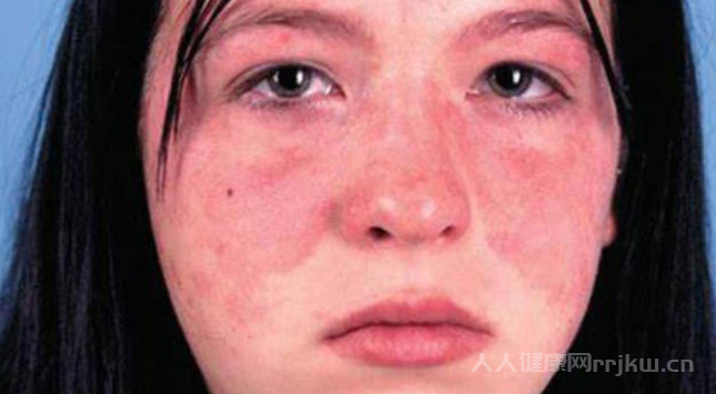 哪種女人最容易得紅斑狼瘡,女人得紅斑狼瘡是什么因素