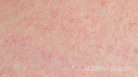 得了蕁麻疹可以用硫磺皂洗澡嗎？
