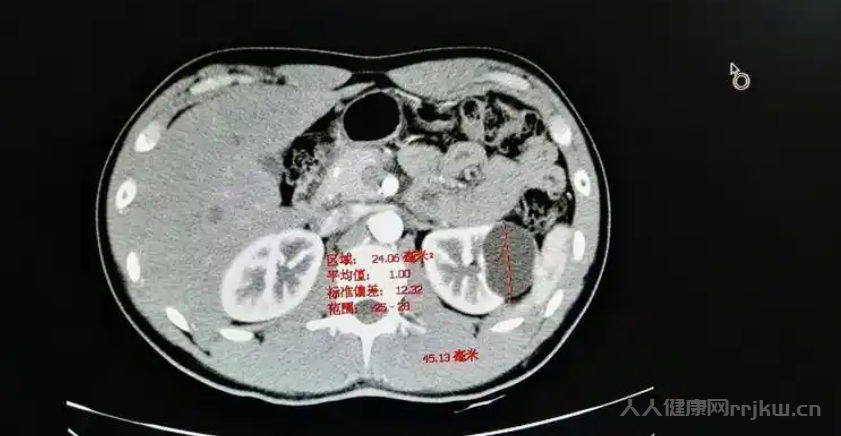 腎囊腫會自己消失嗎