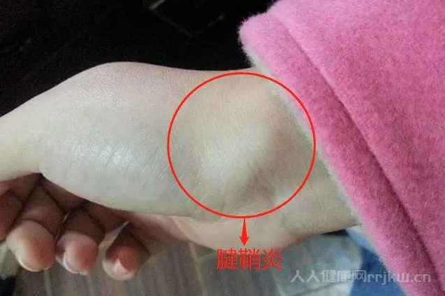 腱鞘炎的癥狀有哪些