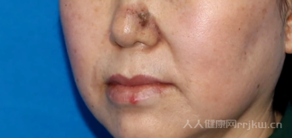鼻子長腫瘤是什么原因