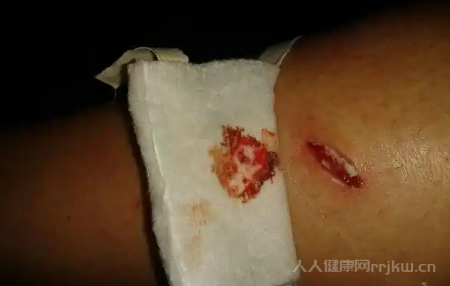 感染破傷風的幾率有多大