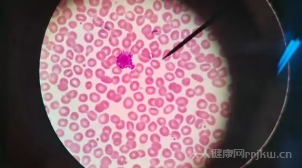 嗜堿性粒細胞偏高0.1對身體有什么影響
