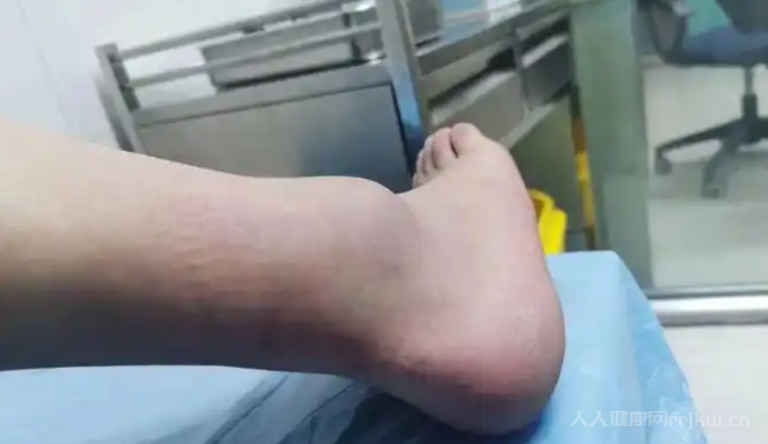韌帶損傷多久能恢復正常