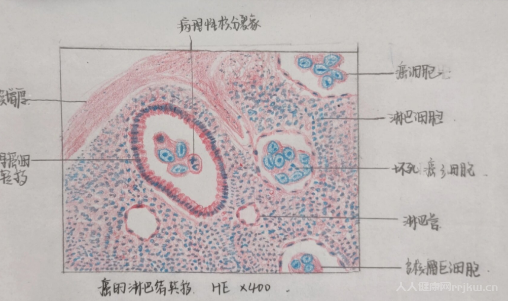 癌癥為什么會轉移淋巴癌