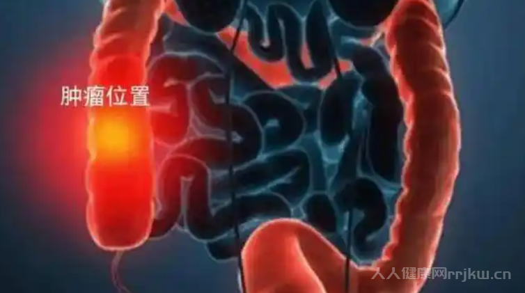 盲腸癌晚期還能活多久